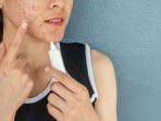 atasi jerawat kenali apa itu acne spot treatment dan cara kerjanya a8efb67